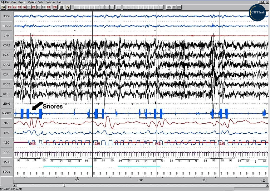 Assessment - EEG of OSA